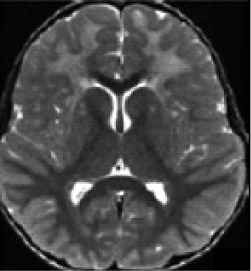 MRI image of a brain with frontally predominant cerebral white matter abnormalities.