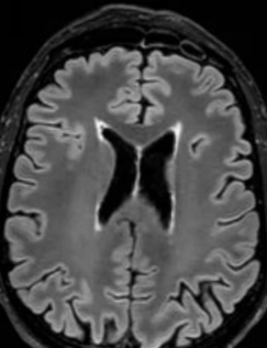 MRI image of moderate supratentorial periventricular white matter abnormalities.