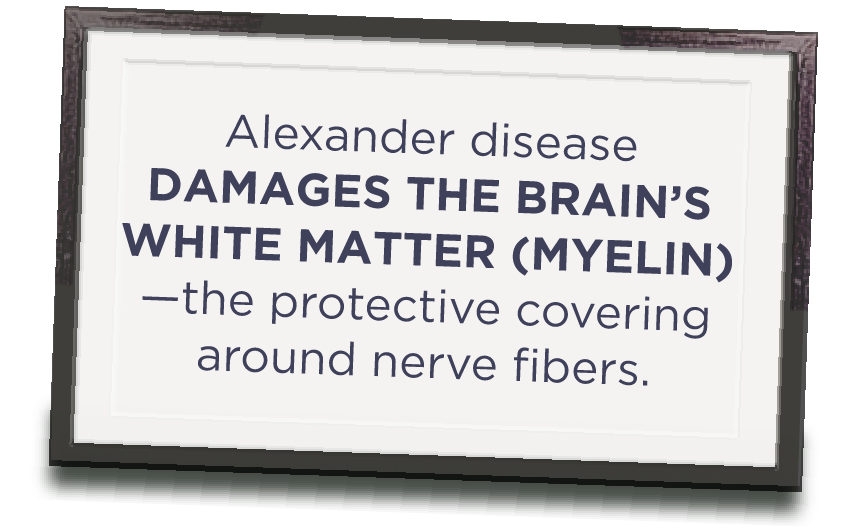Poster with the phrase “Alexander disease damages the brain’s white matter (myelin)—the protective covering around nerve fibers.”